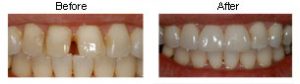 Veneers1