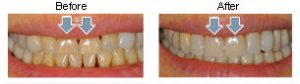 Veneers4